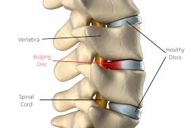 Will a Herniated Lumbar Disc Heal? Understanding the Recovery Process